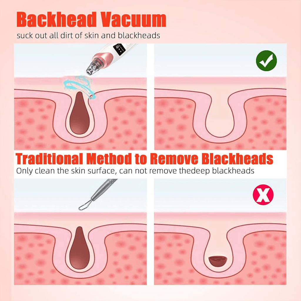 Vacuum Blackhead Remover – Suction Device, Pore Cleaner & Facial Skin Extractor Tool
